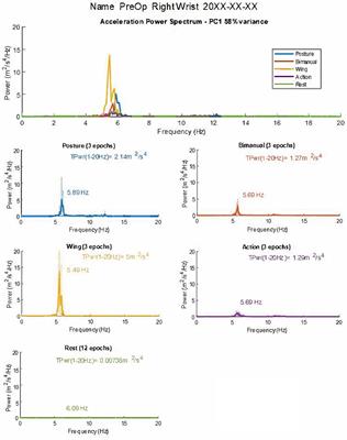 A standardized accelerometry method for characterizing tremor: Application and validation in an ageing population with postural and action tremor